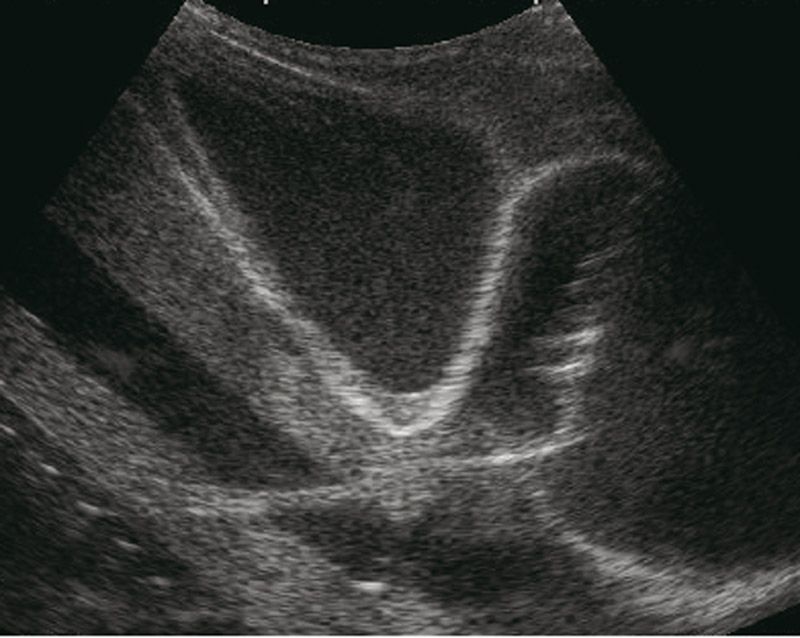 Ultrasound Guided Pericardiocentesis Simulator R