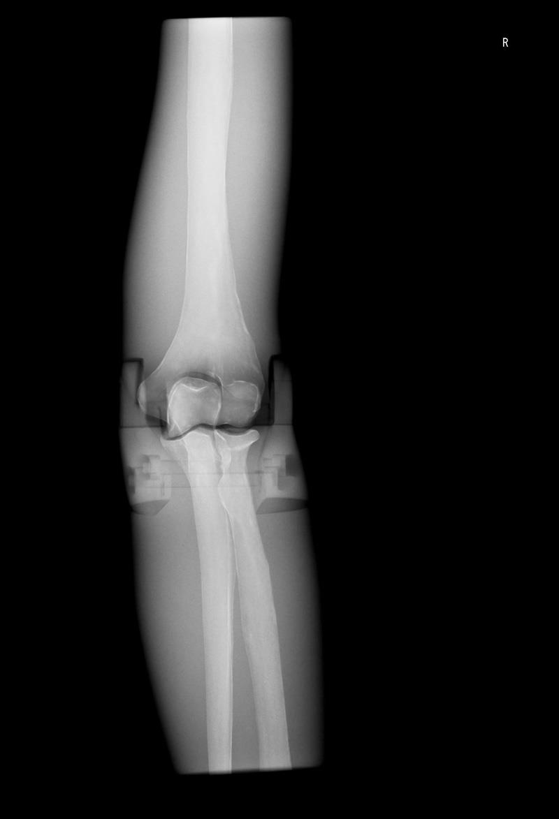 Röntgen-Teilphantom mit künstlichen Knochen - Rechter Ellenbogen, opak