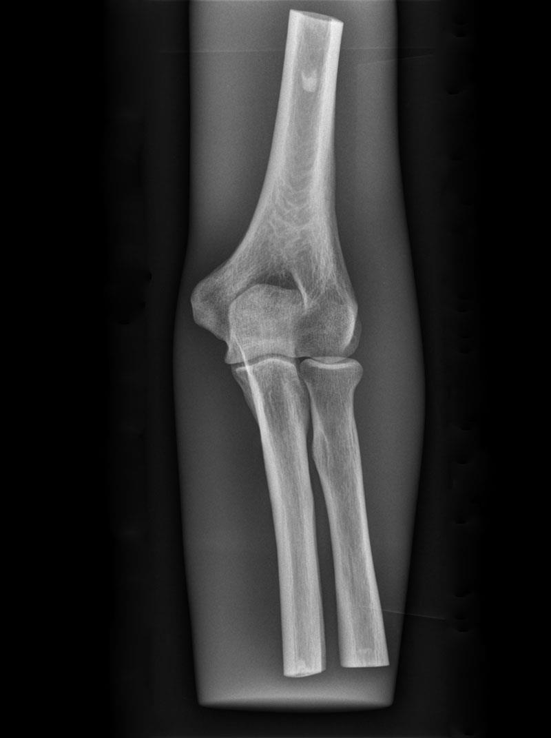 X-Ray Phantom Elbow, opaque