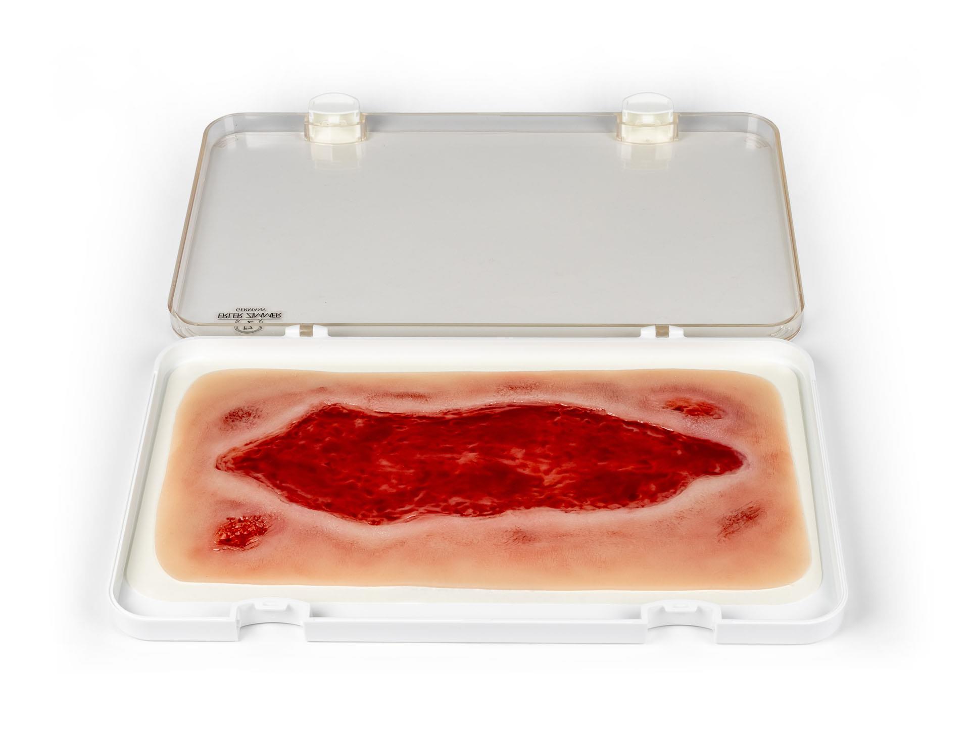 Wundmoulage-Ulcus-Cruris-Arteriosum-groß-Granulationsphase