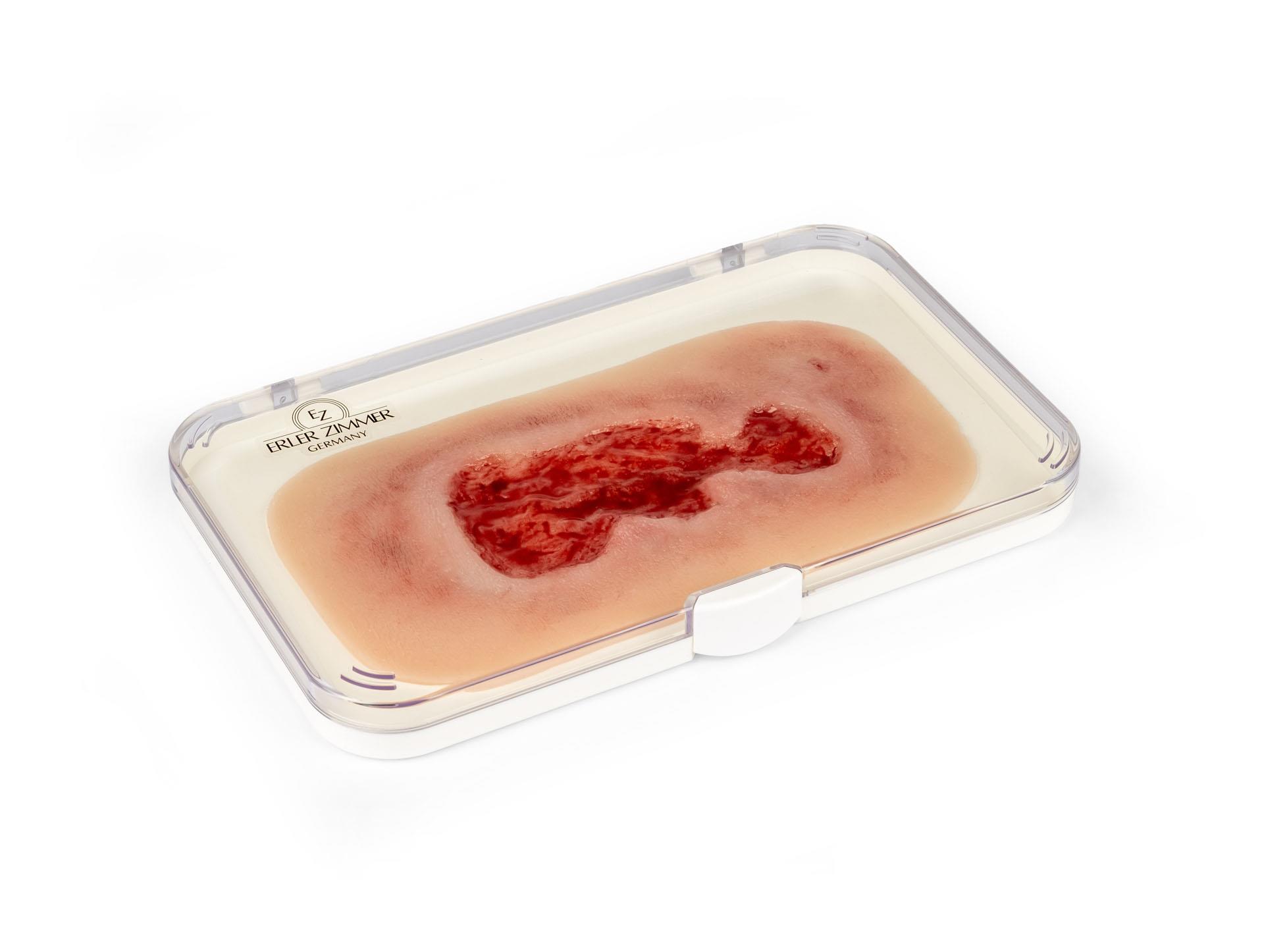 Wound-moulage-venous-leg-ulcer-small-granulation-phase-1