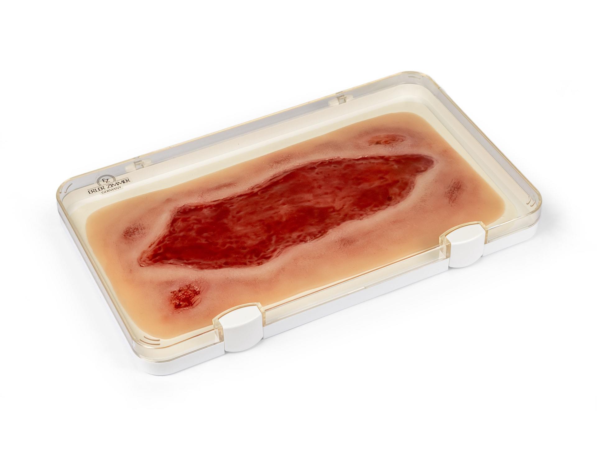 Wound-moulage-arterial-leg-ulcer-large-granulation-phase-1