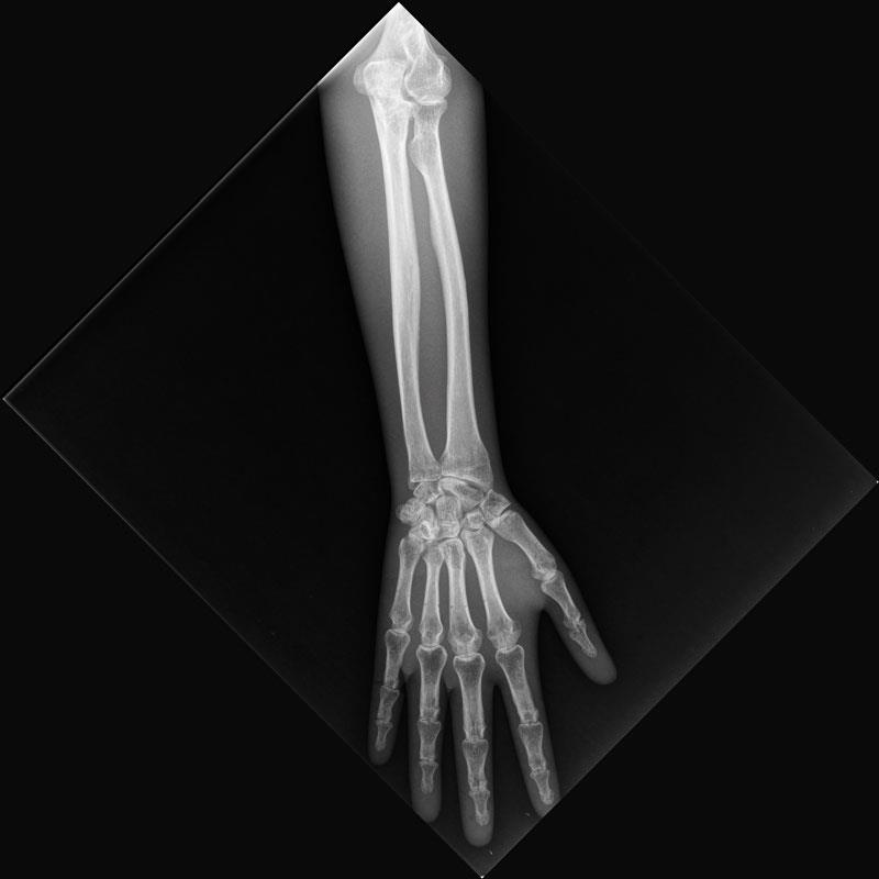 Fantôme de test pour radiographie - avant-bras, opaque