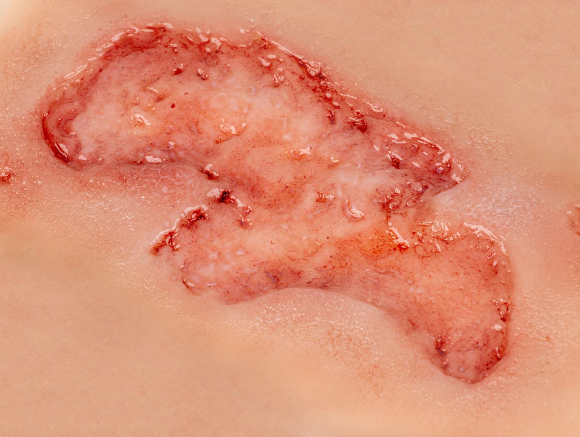 Wound-moulage-arterial-leg-ulcer-small-epithelization-phase-4