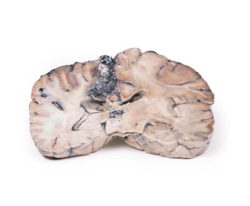 Cerebral Arterio-Venous Malformation