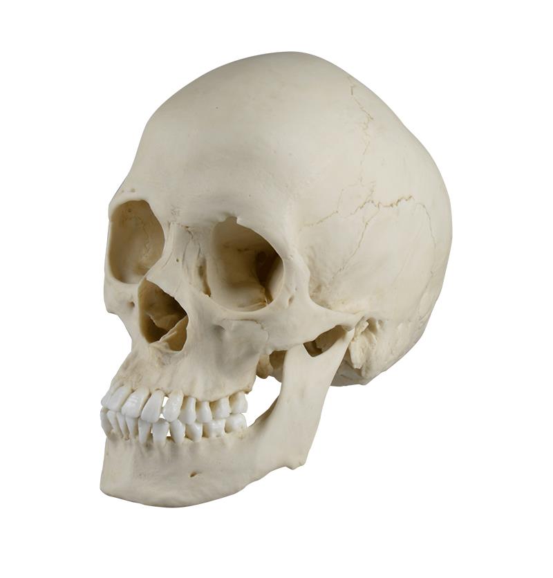 Scaphocephalic skull