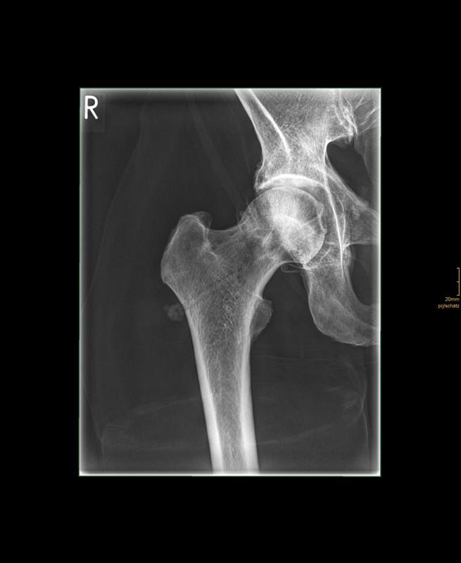 Röntgenphantom-Hüfte-flexibel-5