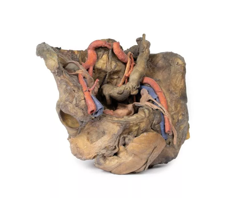 Female pelvis deep dissection