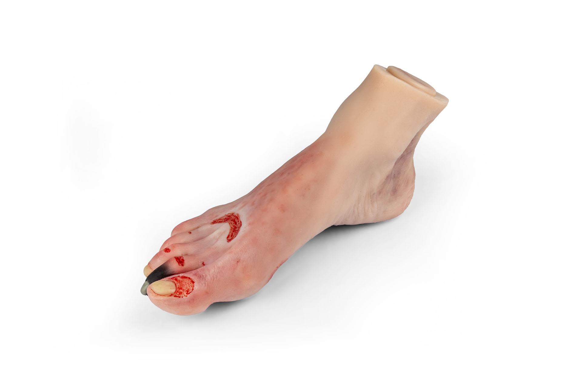 Wound-foot-with-diabetic-foot-syndrome-2