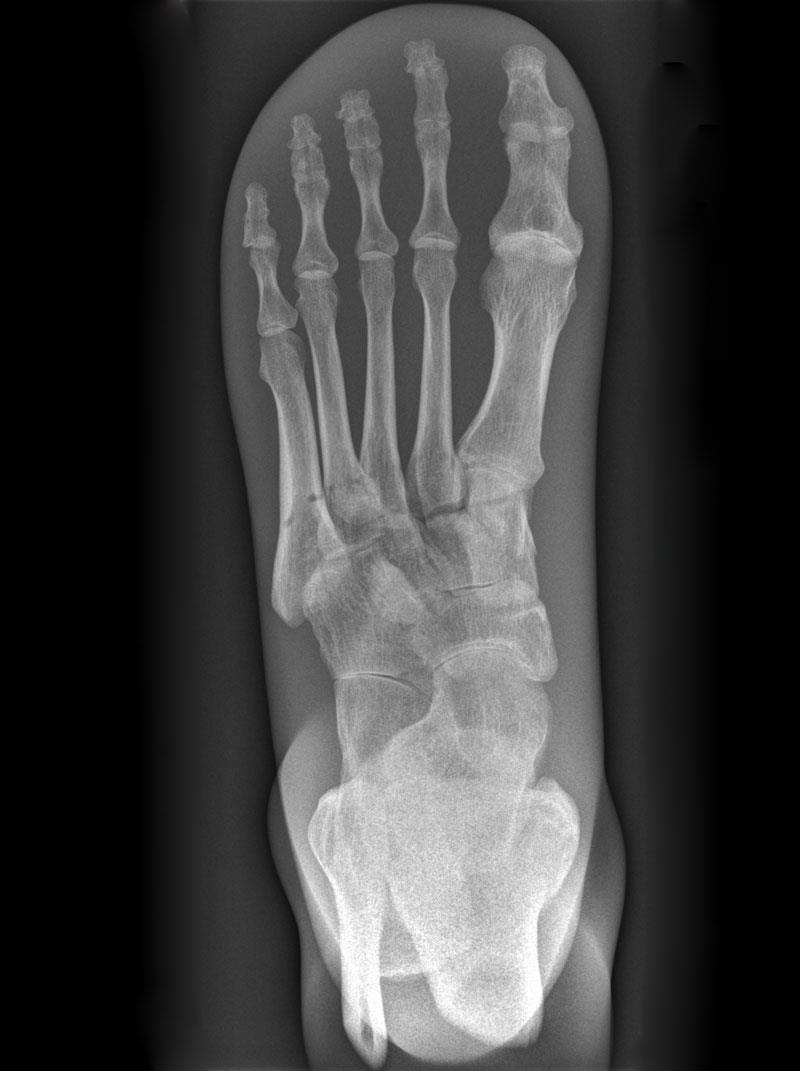 Fantôme de test pour radiographie - pied, opaque