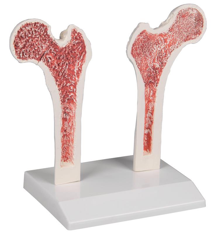 Osteoporose-Oberschenkel