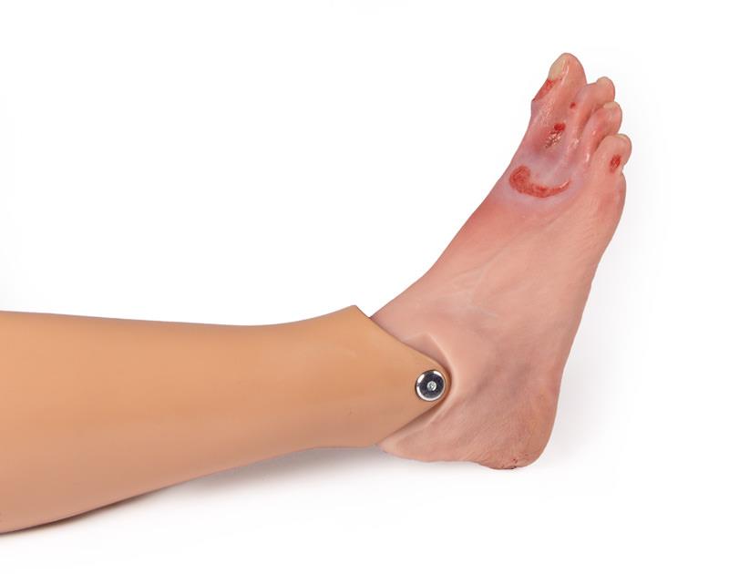 Wundenfuß-mit-diabetischem-Fußsyndrom-fortg-Stadium-für-Nursing-Anne-9