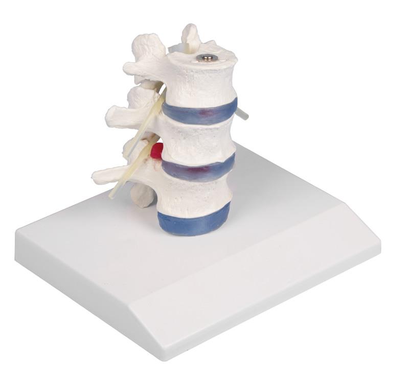 Lumbar vertebrae with prolapsed inter vertebral discs with stand