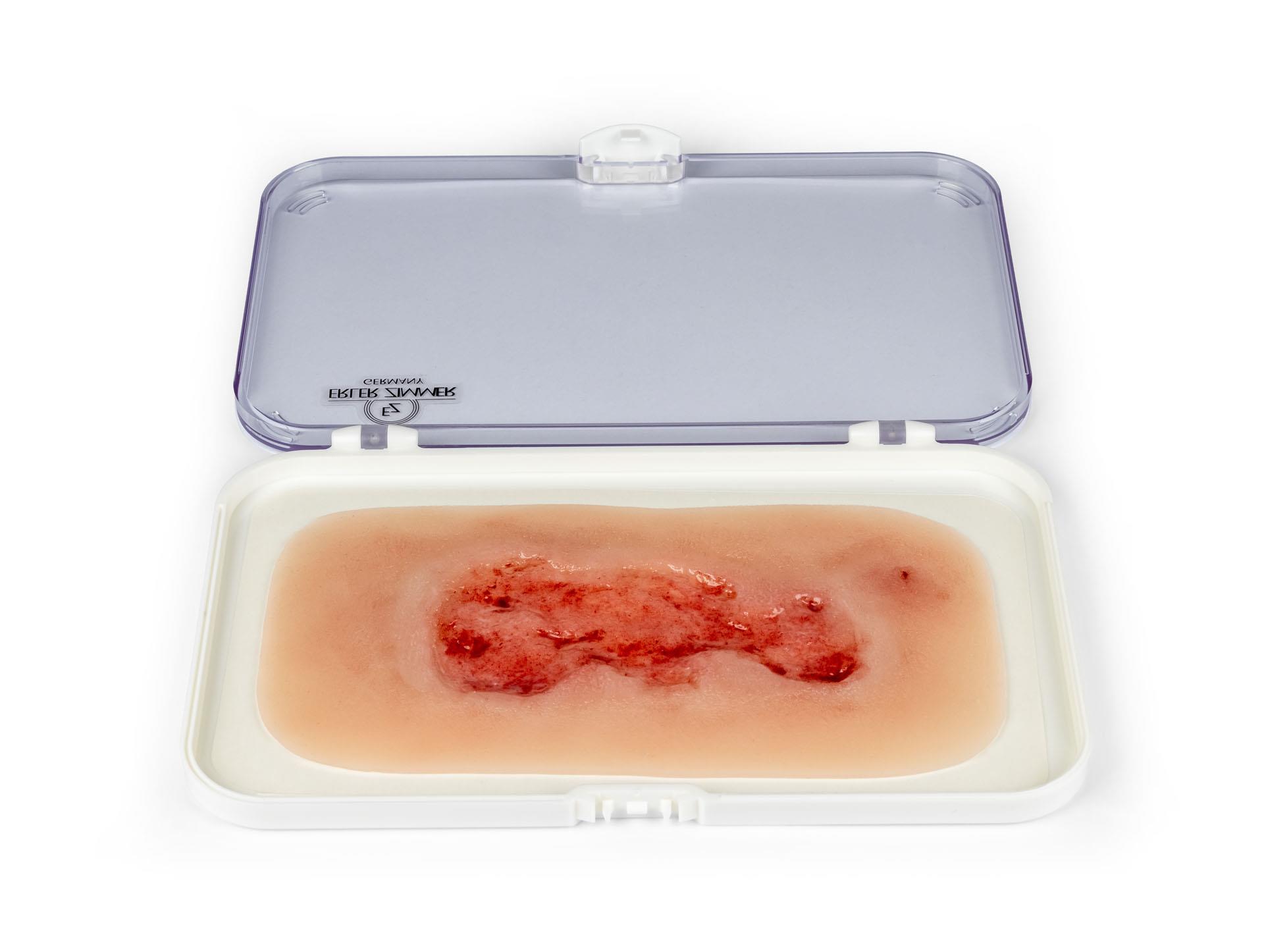 Wundmoulage-Ulcus-Cruris-Venosum-klein-Epithelisierungsphase