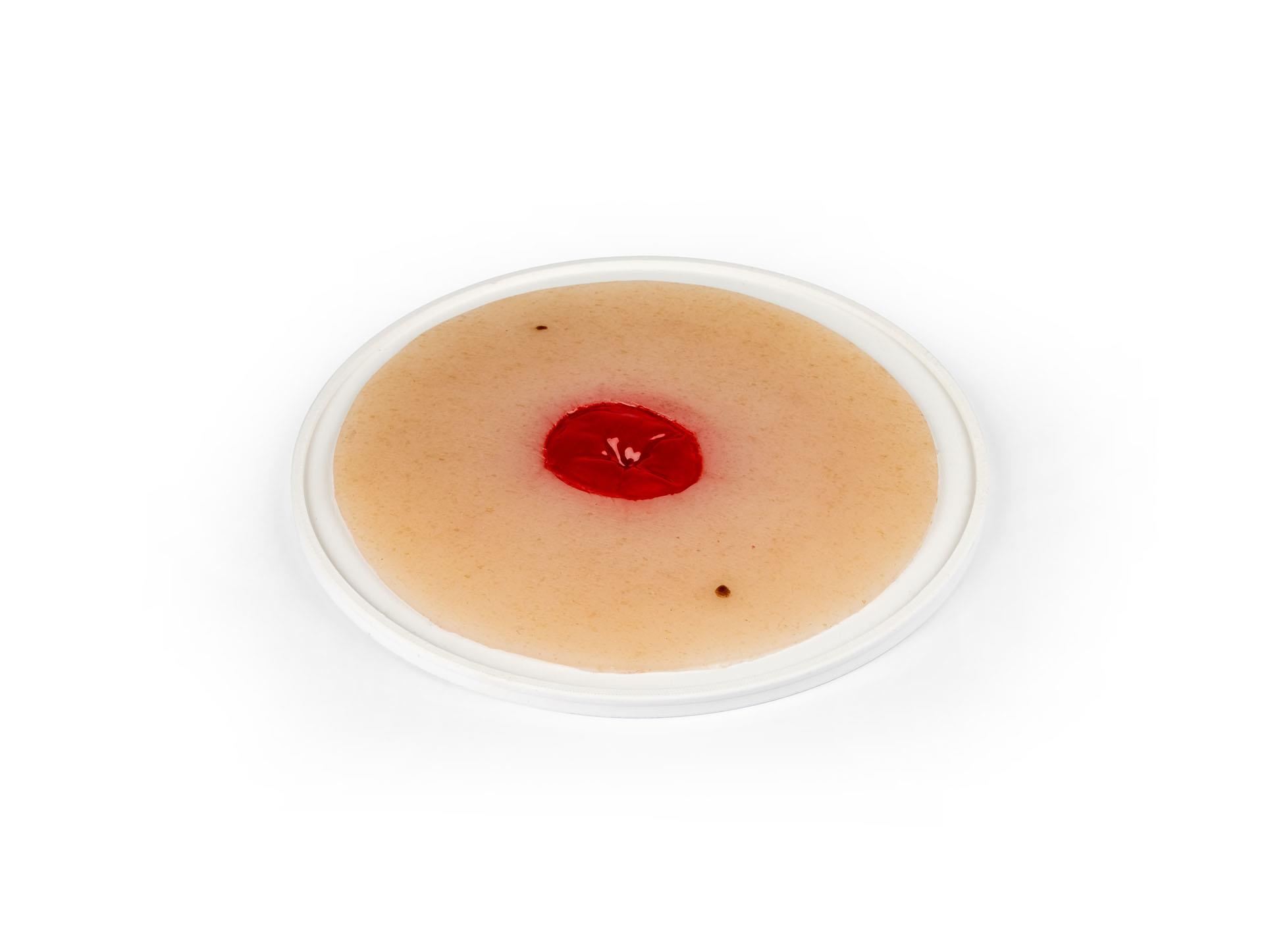 Wundmoulage-Kolostoma-unter-Hautniveau-selbsthaftend