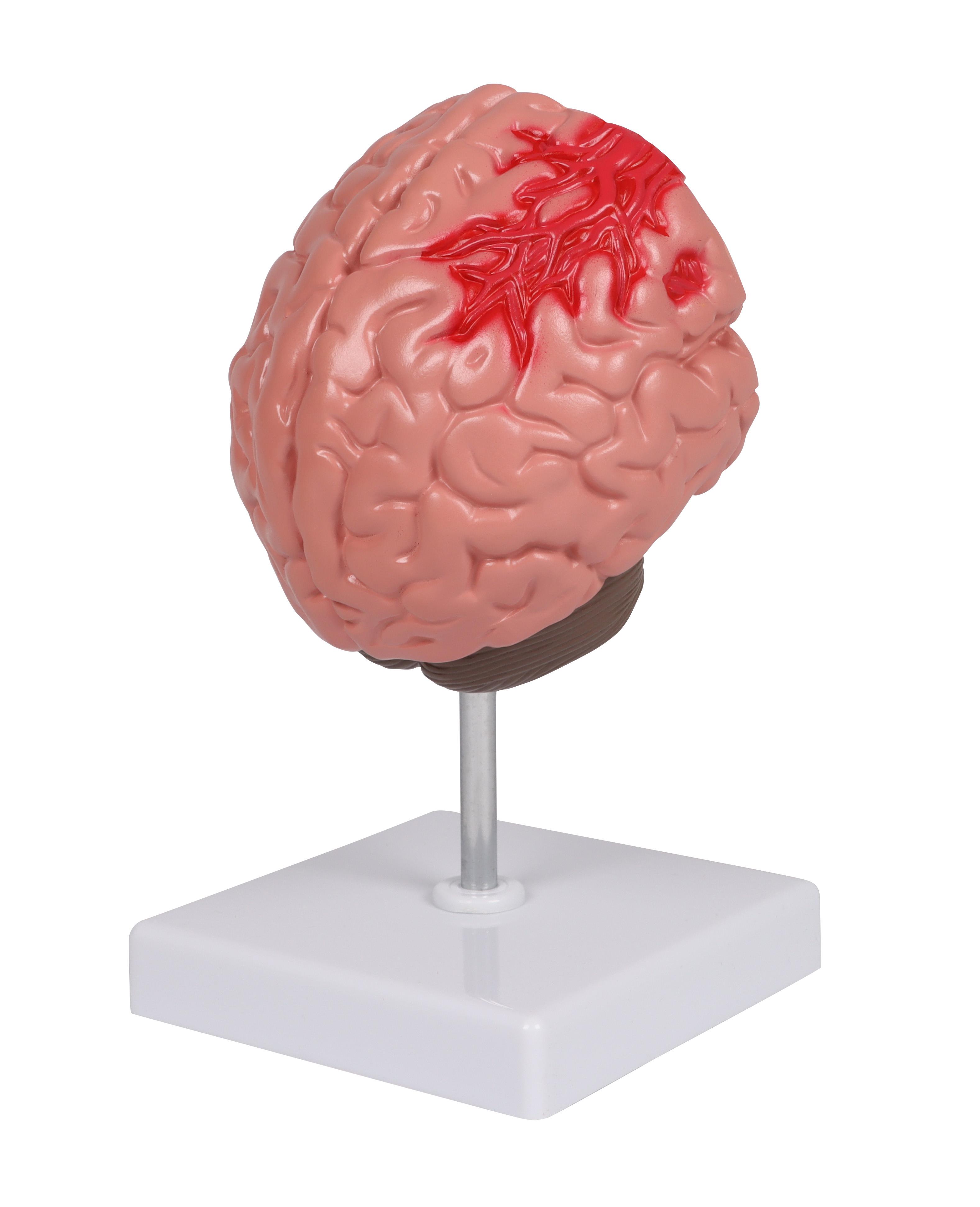 Pathologien-des-Gehirns-lebensgröße