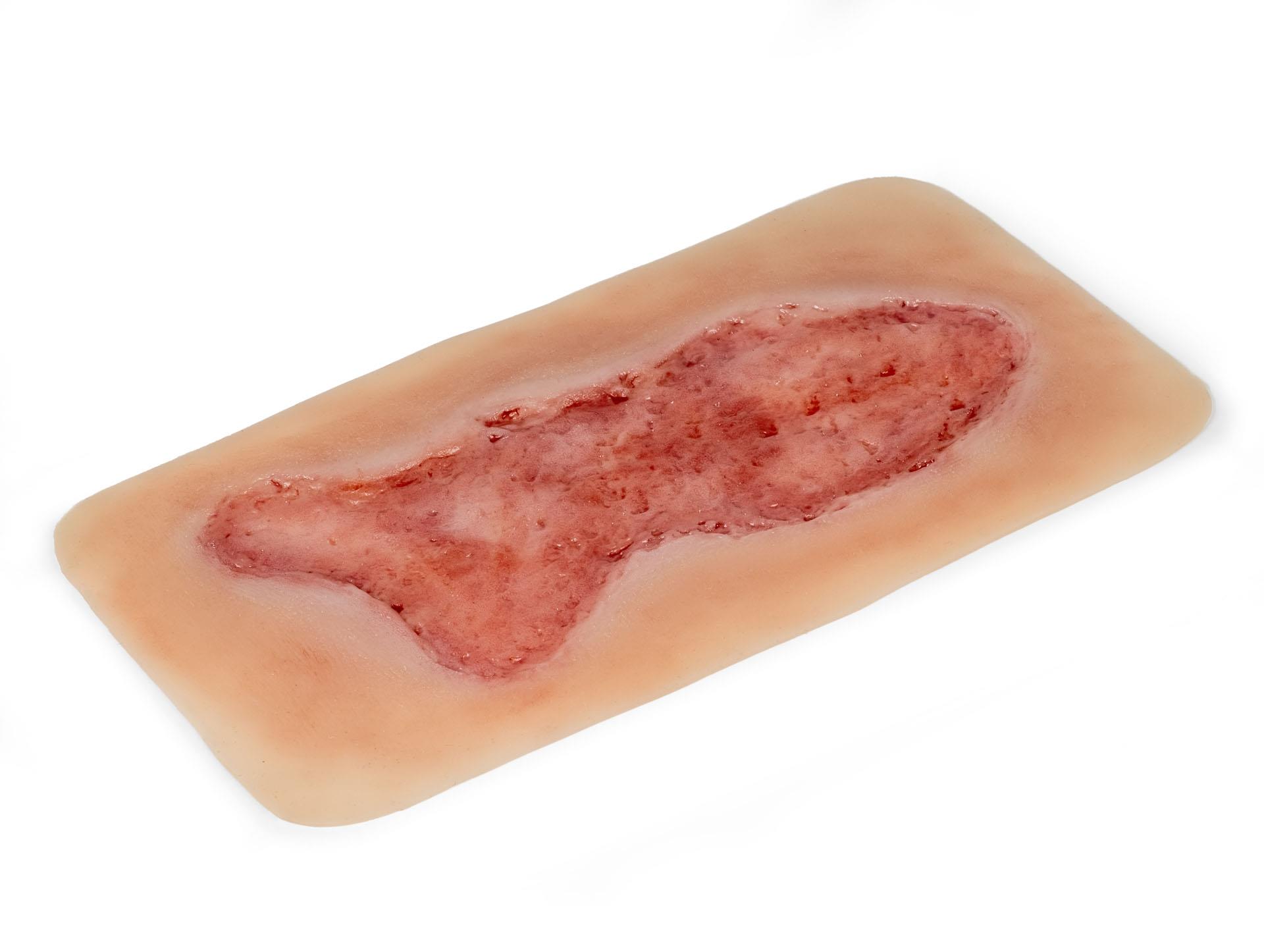 Wound-moulage-venous-leg-ulcer-large-epithelisation phase-2