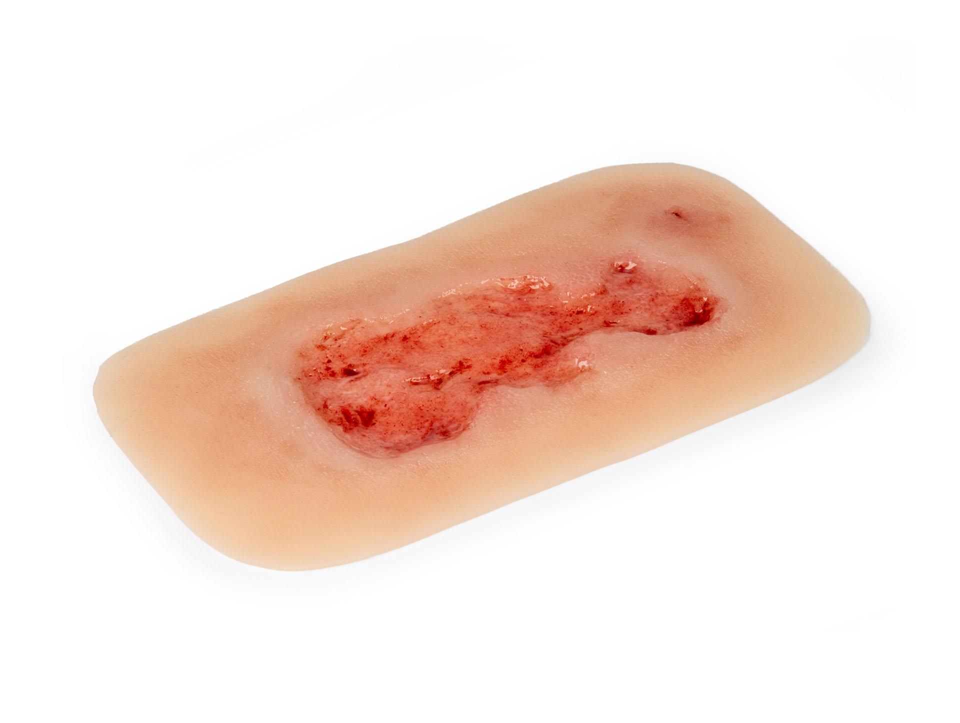 Wound-moulage-venous-leg-ulcer-small-epithelisation-phase-2