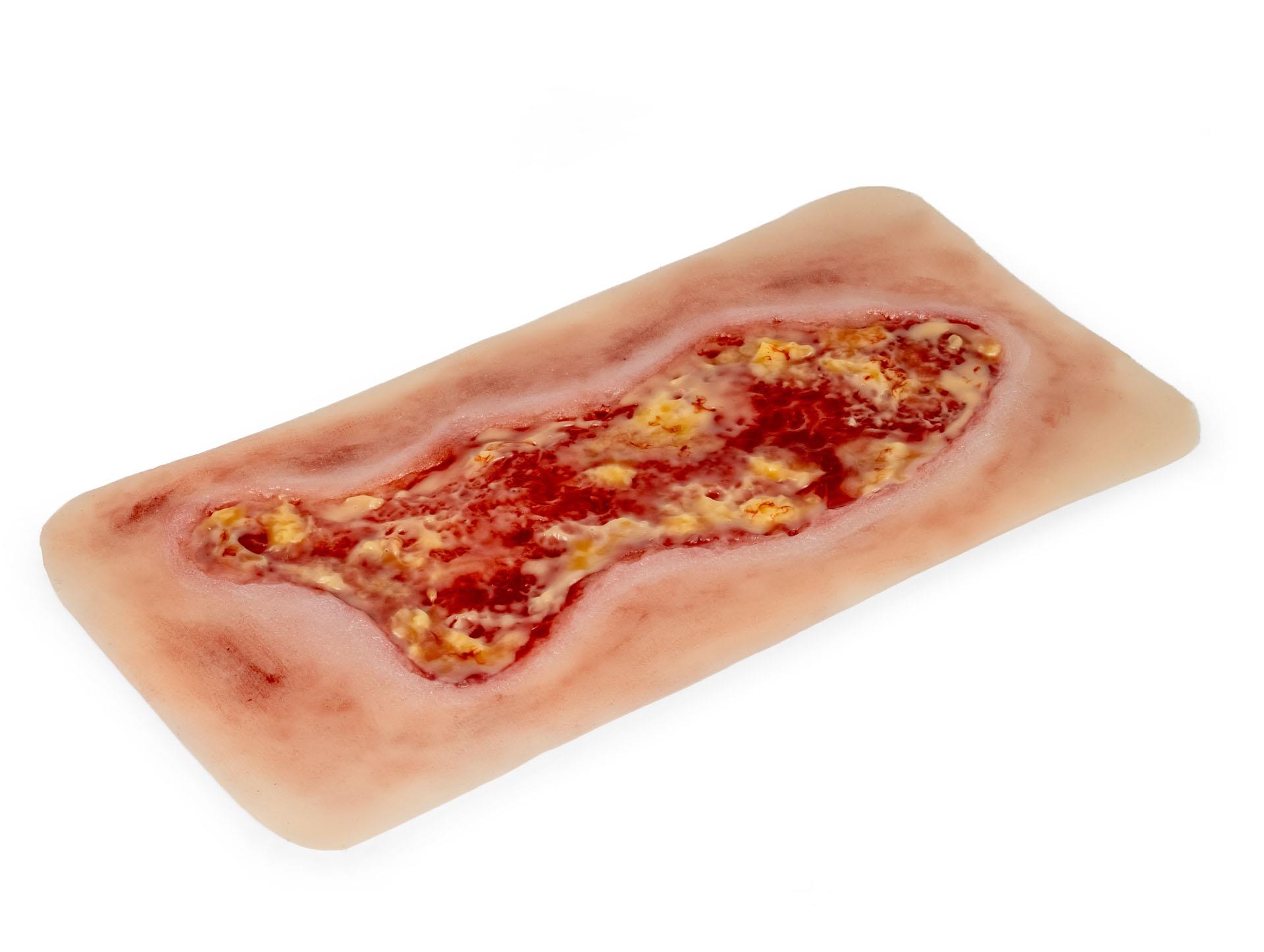 Wound-moulage-venous-leg-ulcer-large-exudation-phase-2