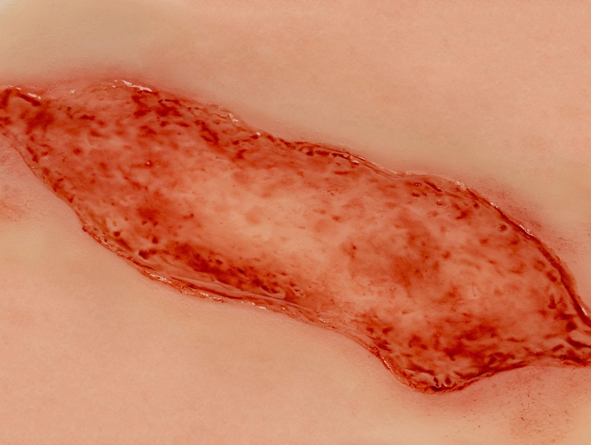 Wundmoulage-Ulcus-Cruris-Arteriosum-groß-Epithelisierungsphase-4