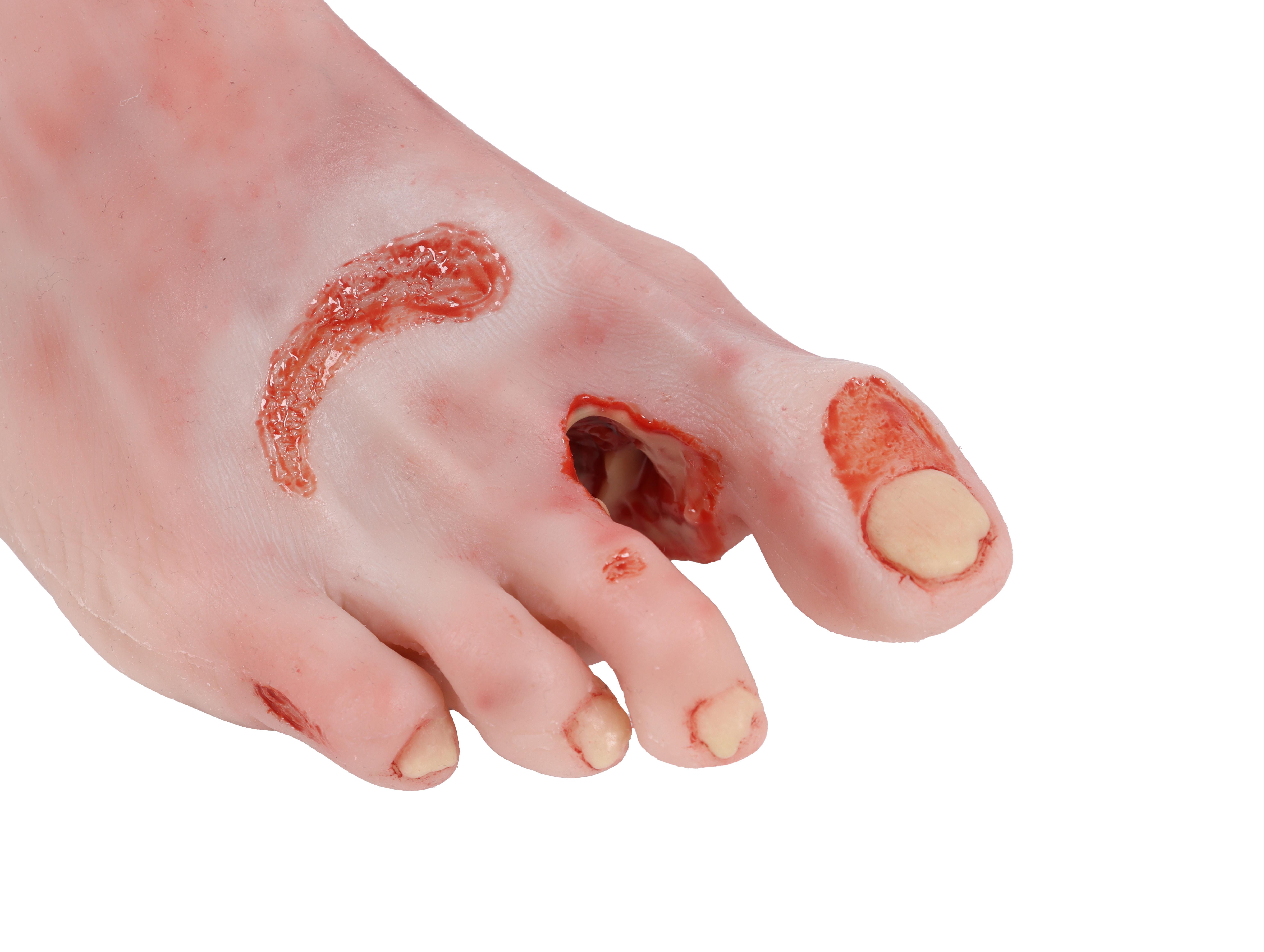 Wound-foot-with-diabetic-foot-syndrome-severe-stage-4