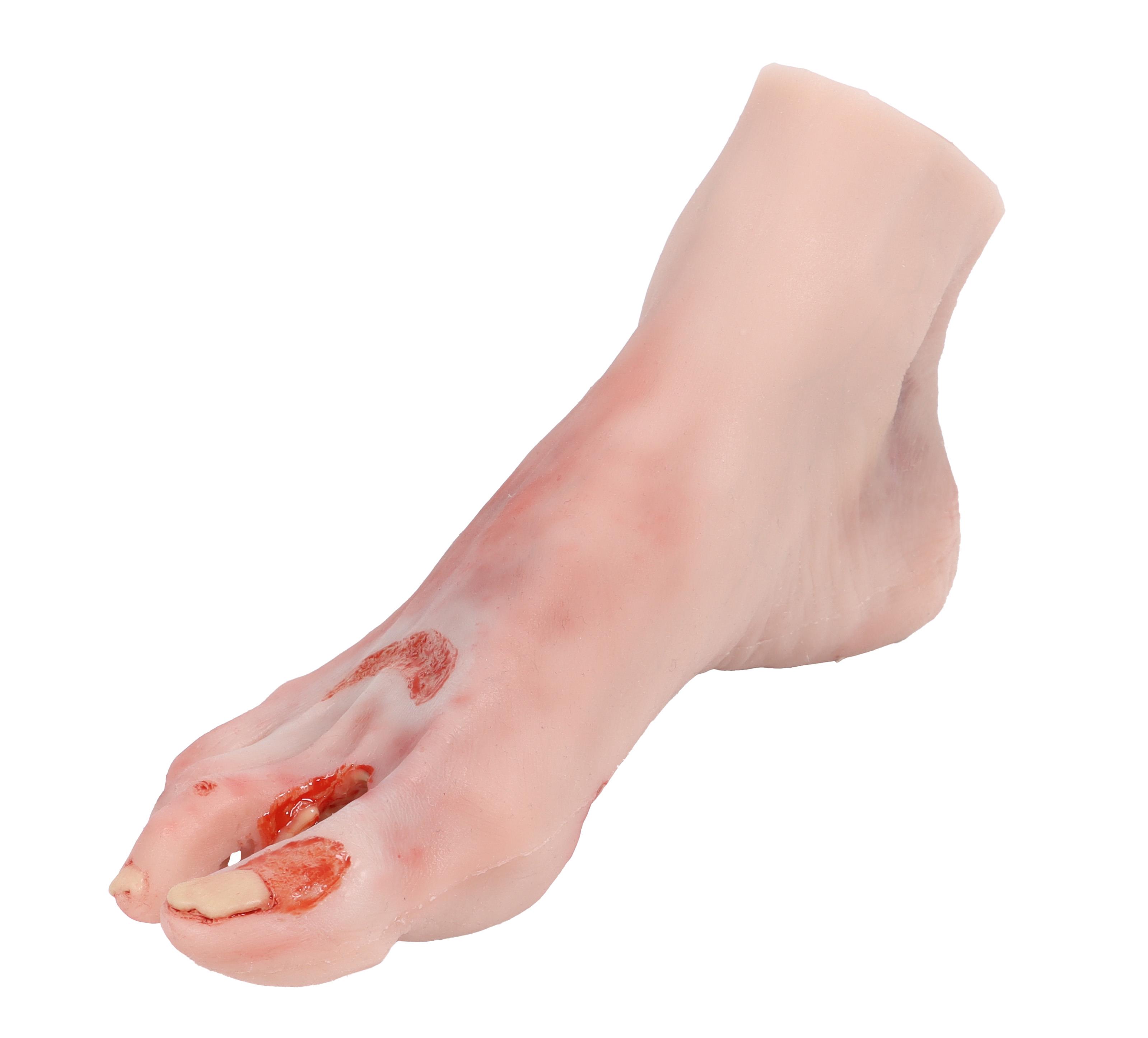 Wound-foot-with-diabetic-foot-syndrome-severe-stage-1