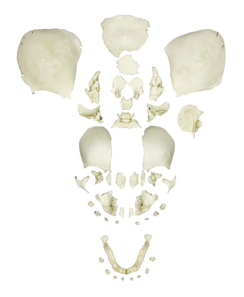 Gesprengter menschlicher Fötusschädel, voll entwickelt