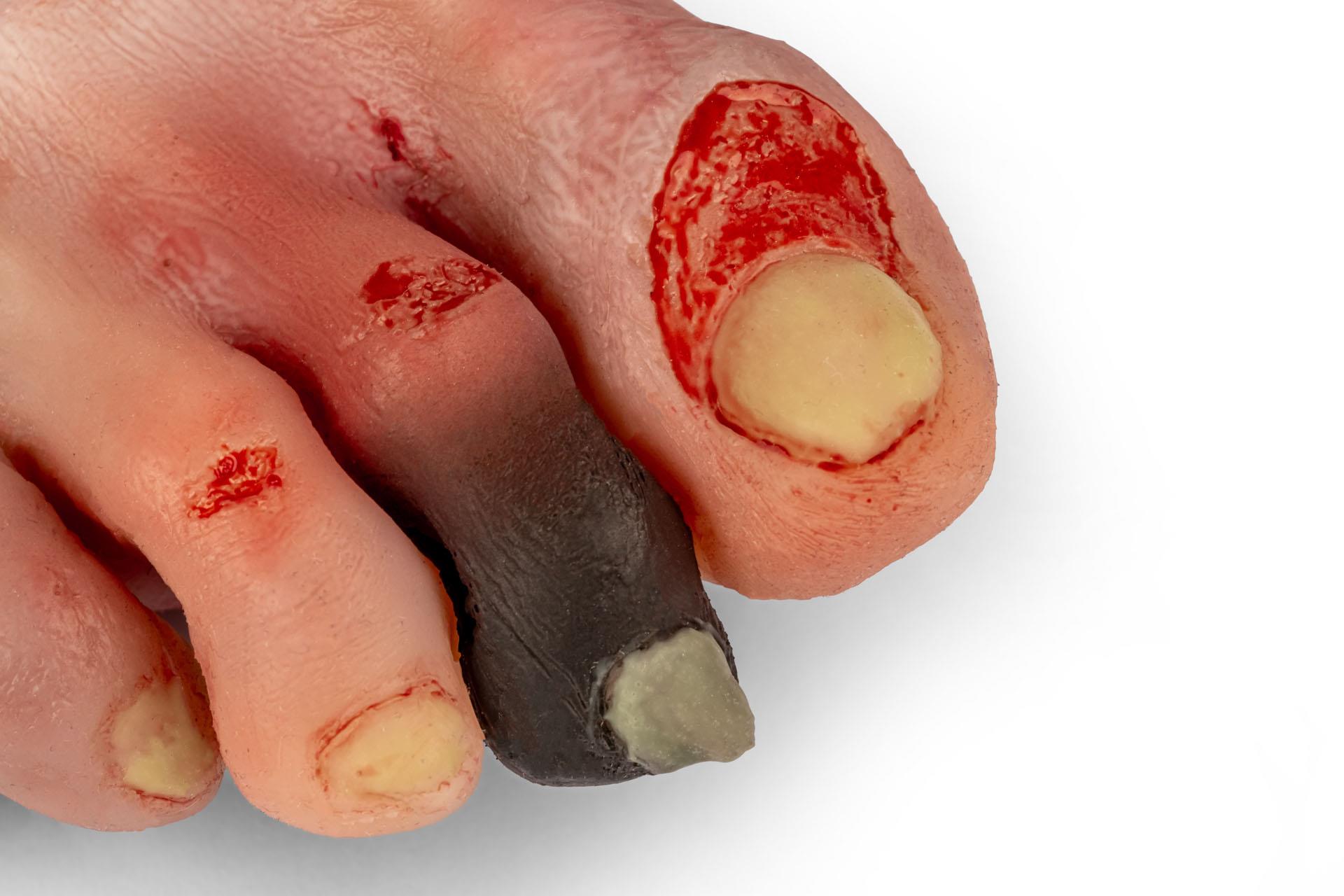 Wound-foot-with-diabetic-foot-syndrome-8