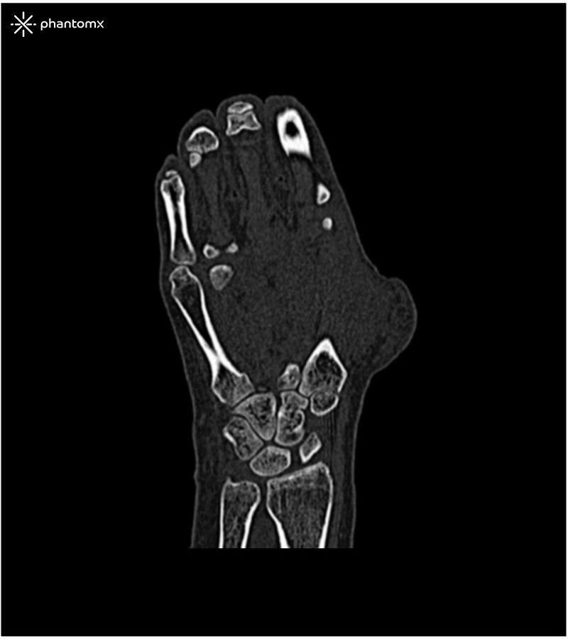 Handphantom-für-CT-Röntgen-und-Strahlentherapie-1