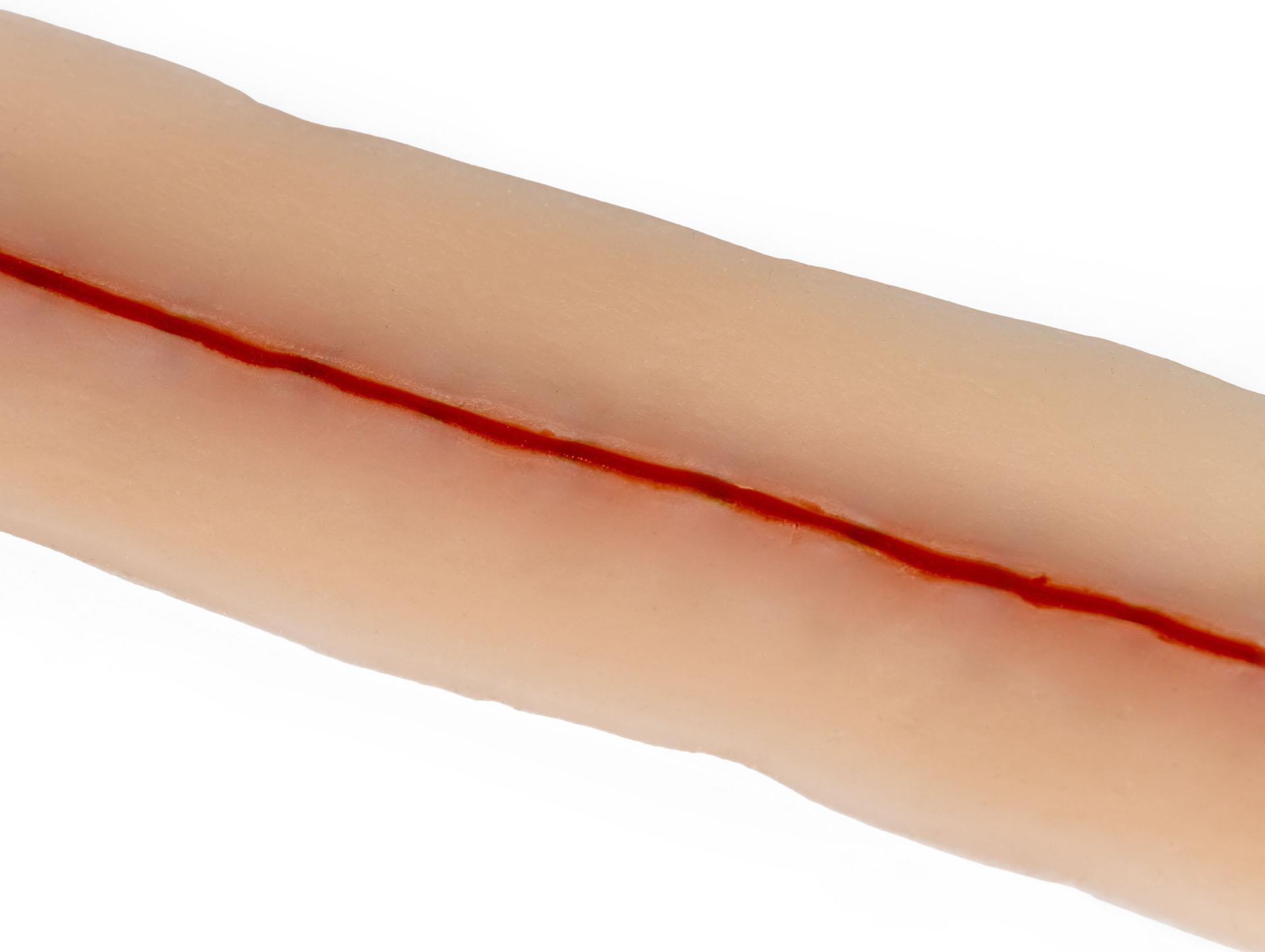 Surgical-wound-without-suture-22cm-1
