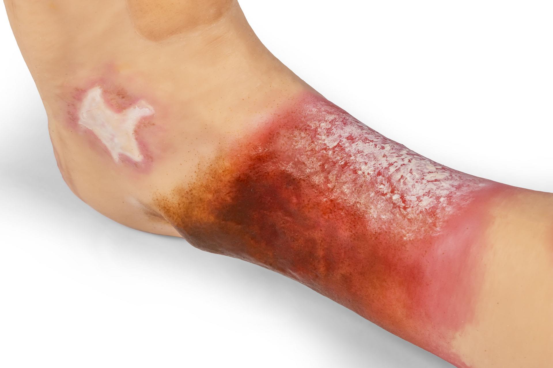 Lena-Leg-Jambe-atteinte-de-maladies-6