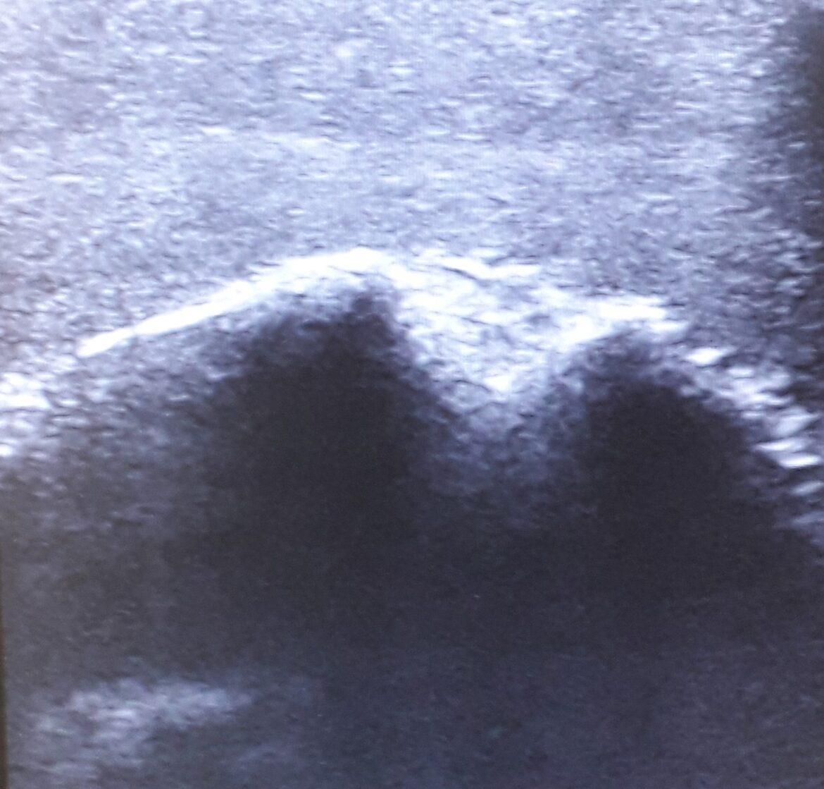 Ultrasound---Exercise-Model-Shoulder-5