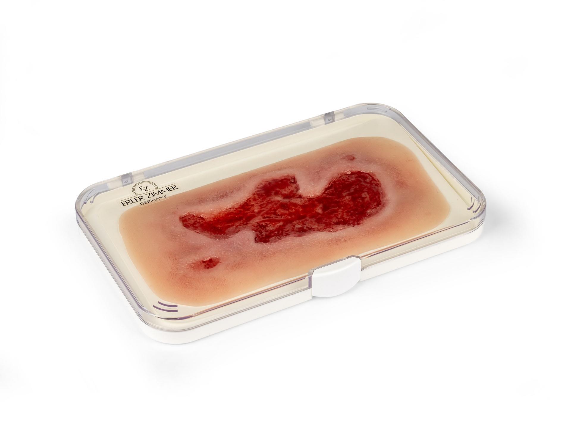 Wundmoulage-Ulcus-Cruris-Arteriosum-klein-Granulationsphase-1