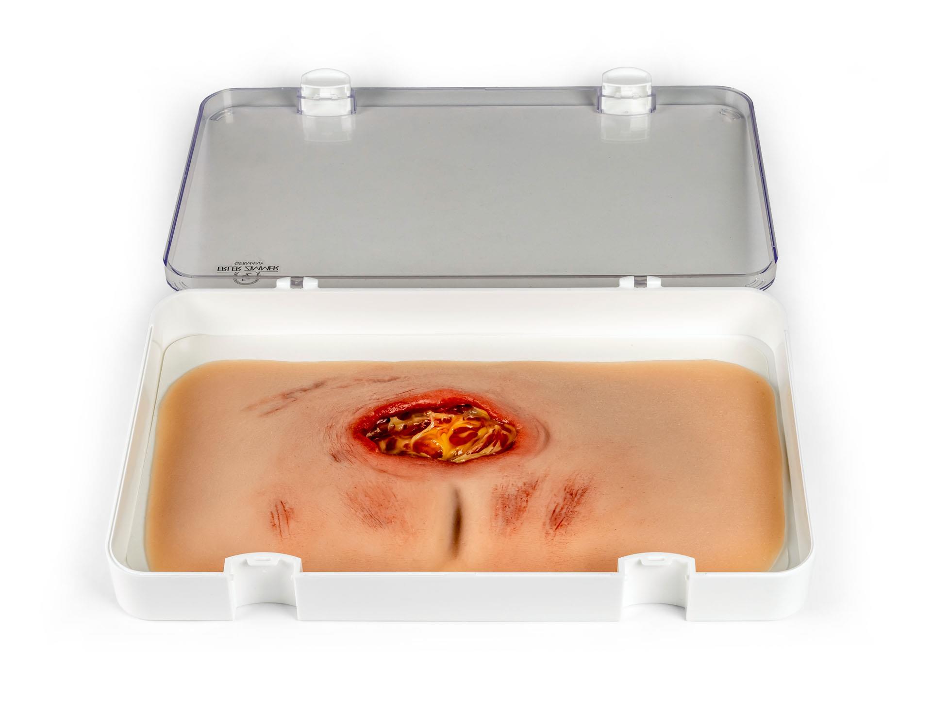 Wundmoulage-sakraler-Dekubitus-gesäubert