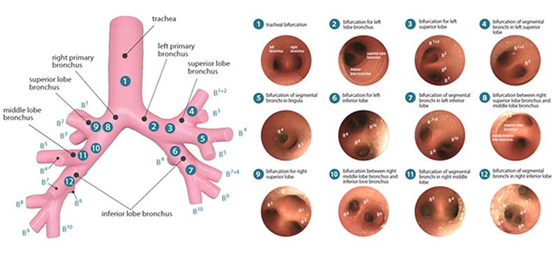 Bronchialbaum für Bronchofiberskopie für R16060