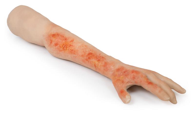 Burnt Arm for ADAM-X Series manikins