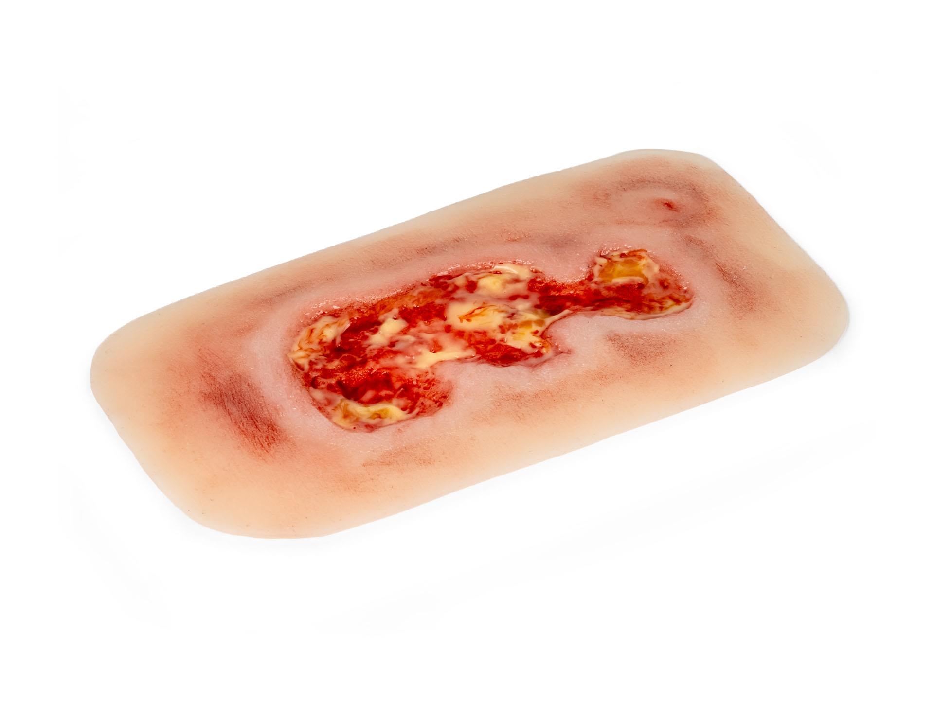 Wound-moulage-venous-leg-ulcer-small-exudation-phase-2