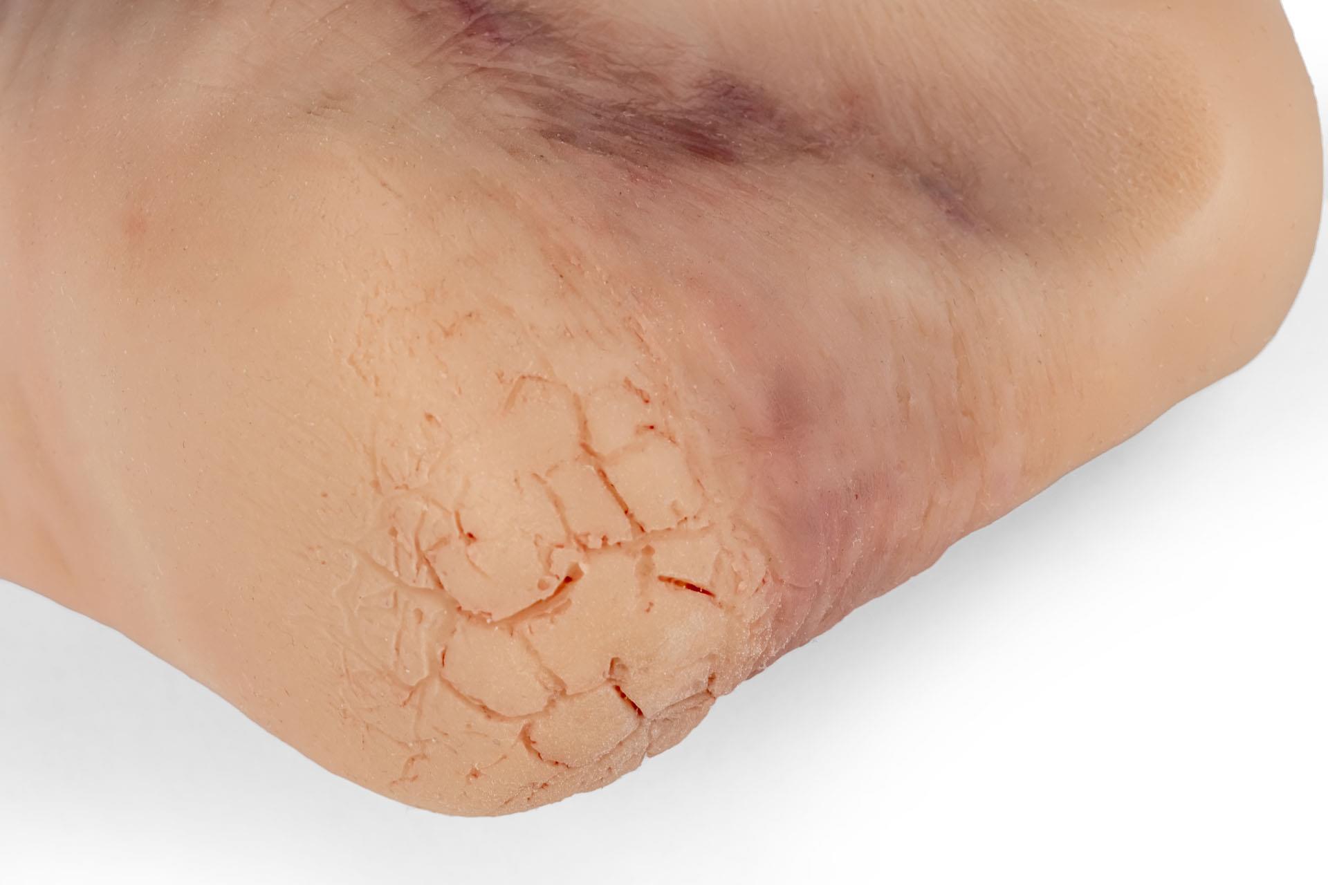 Wundenfuß-mit-diabetischem-Fußsyndrom-fortg-Stadium-für-Nursing-Anne-5