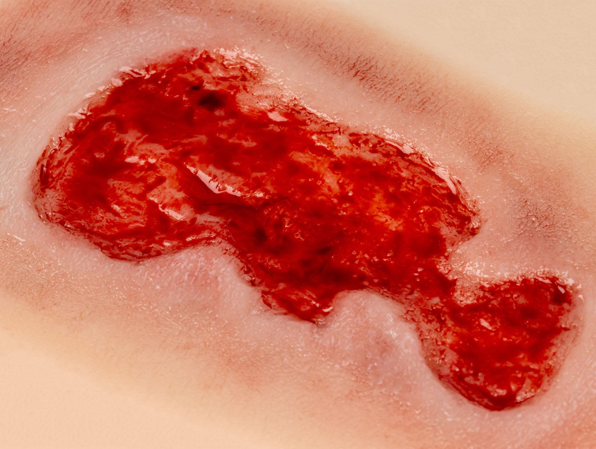 Wound-moulage-venous-leg-ulcer-small-granulation-phase-4
