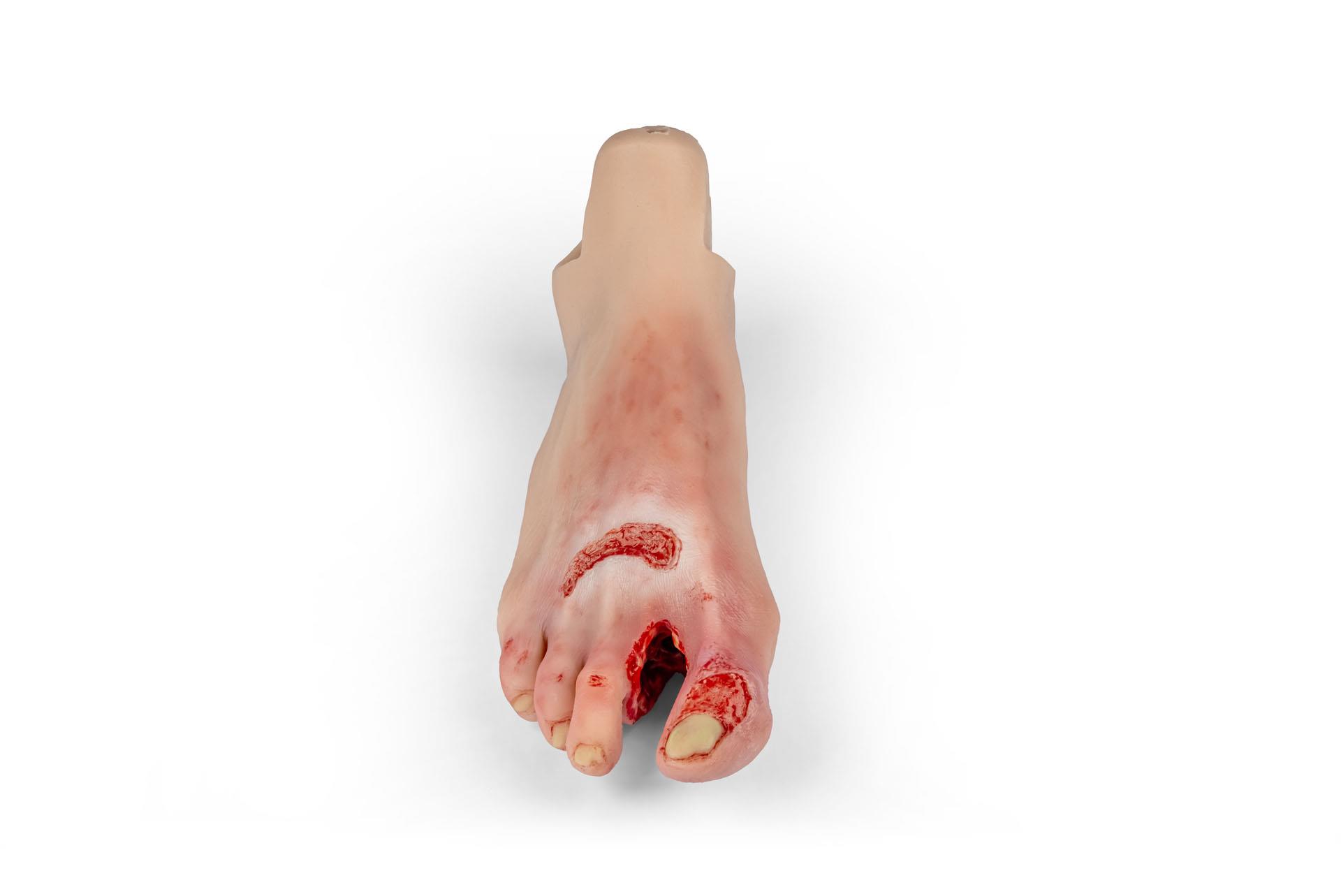 Wundenfuß-mit-diabetischem-Fußsyndrom-fortg-Stadium-für-Nursing-Anne-1