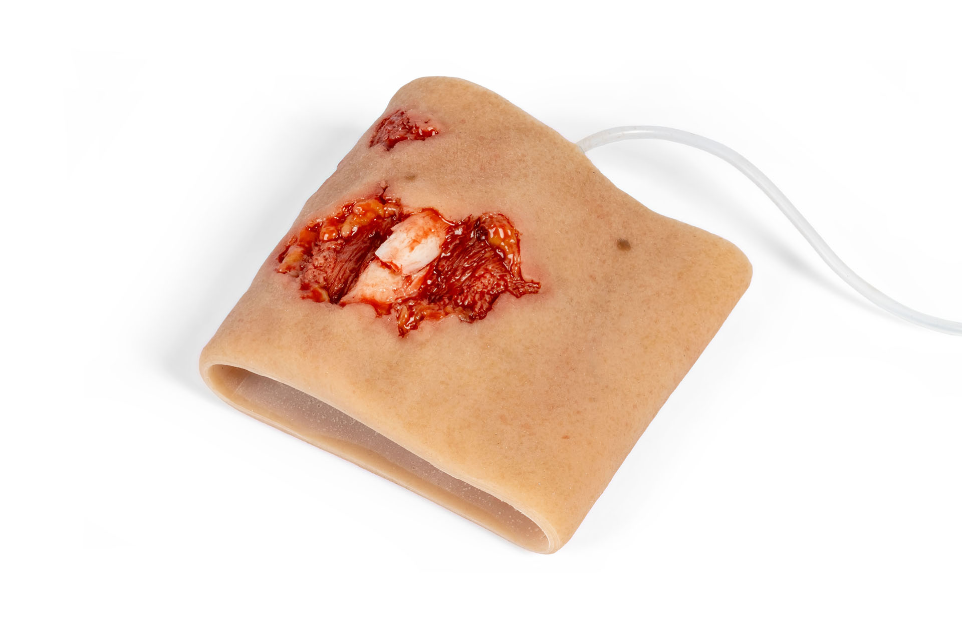 Wound Moulage Sleeve for Open Upper Arm Fracture, with Bleeding Feature