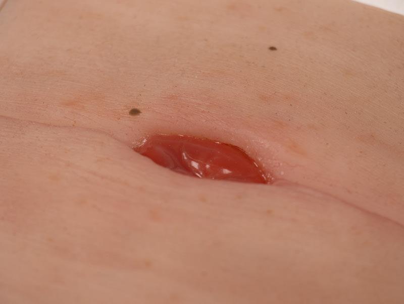 Wound-Moulage-Colostoma-in-abdominal-crease-incl-stand-2