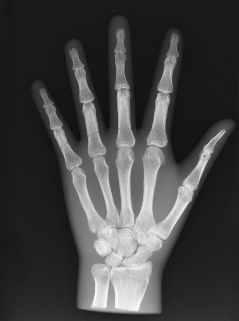 Fantôme de test pour radiographie - main, opaque