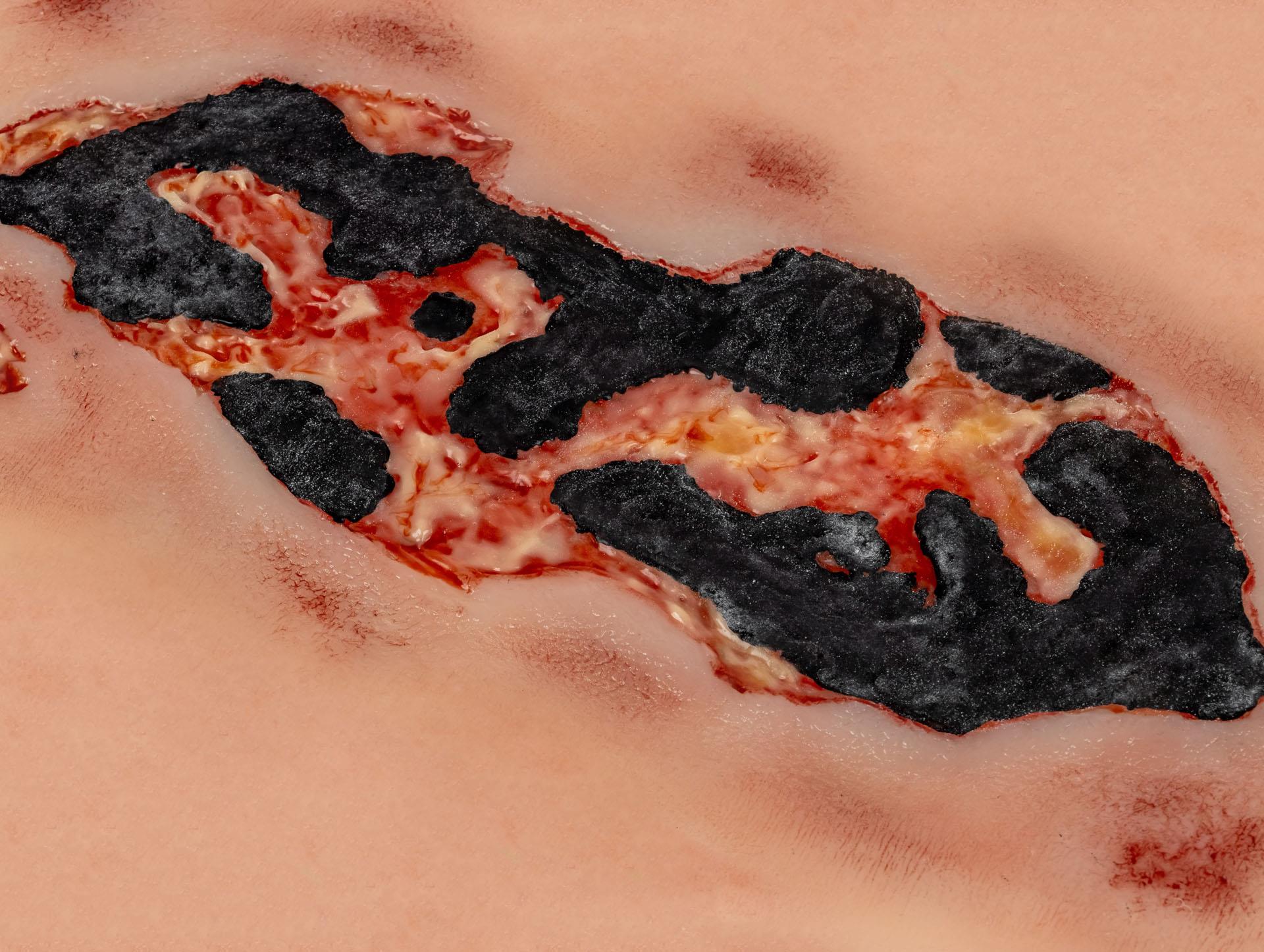 Wundmoulage-Ulcus-Cruris-Arteriosum-groß-Exsudationsphase-4