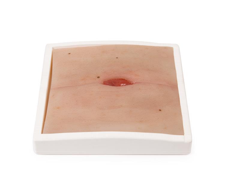 Wound-Moulage-Colostoma-in-abdominal-crease-incl-stand-1