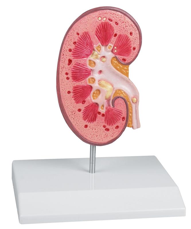 Kidney Stone Model - EZ Augmented Anatomy