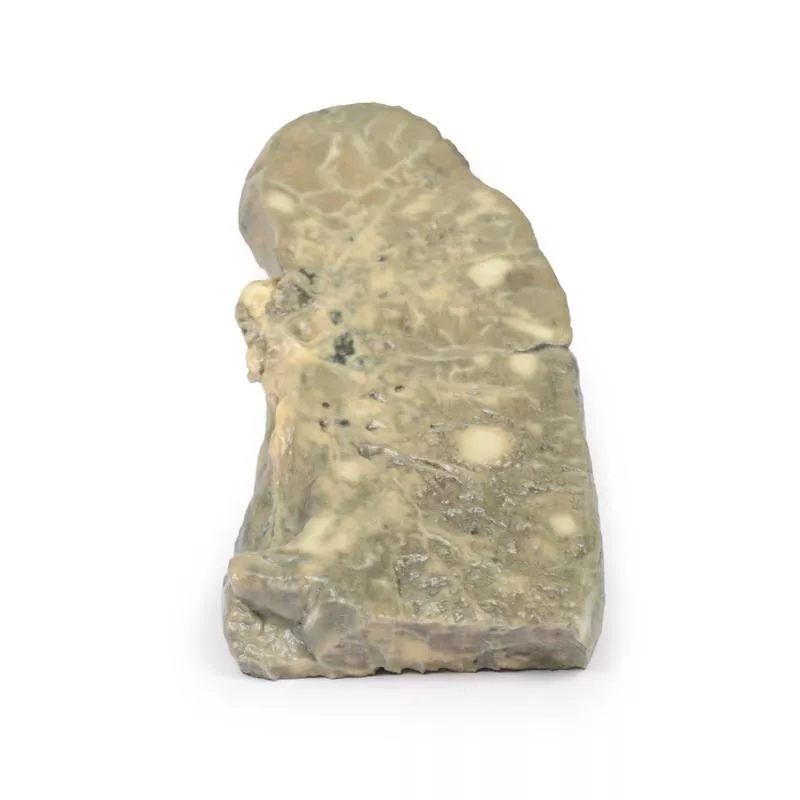 Metastatic carcinoma