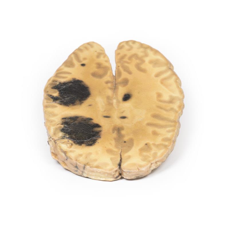 Cerebral Haemorrhage, secondary to Acute Myeloid Leukaemia