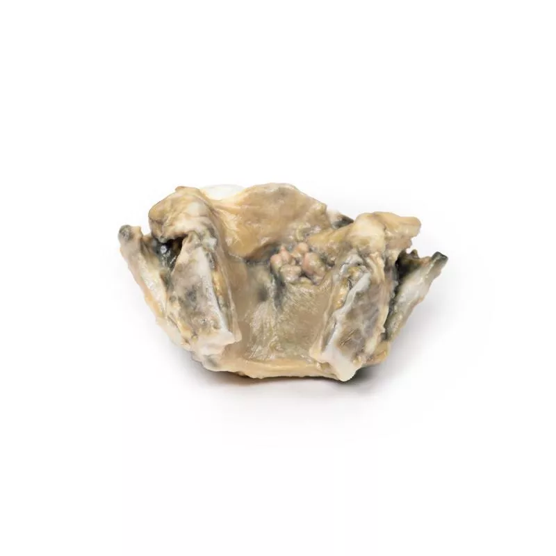 Carcinoma of Larynx