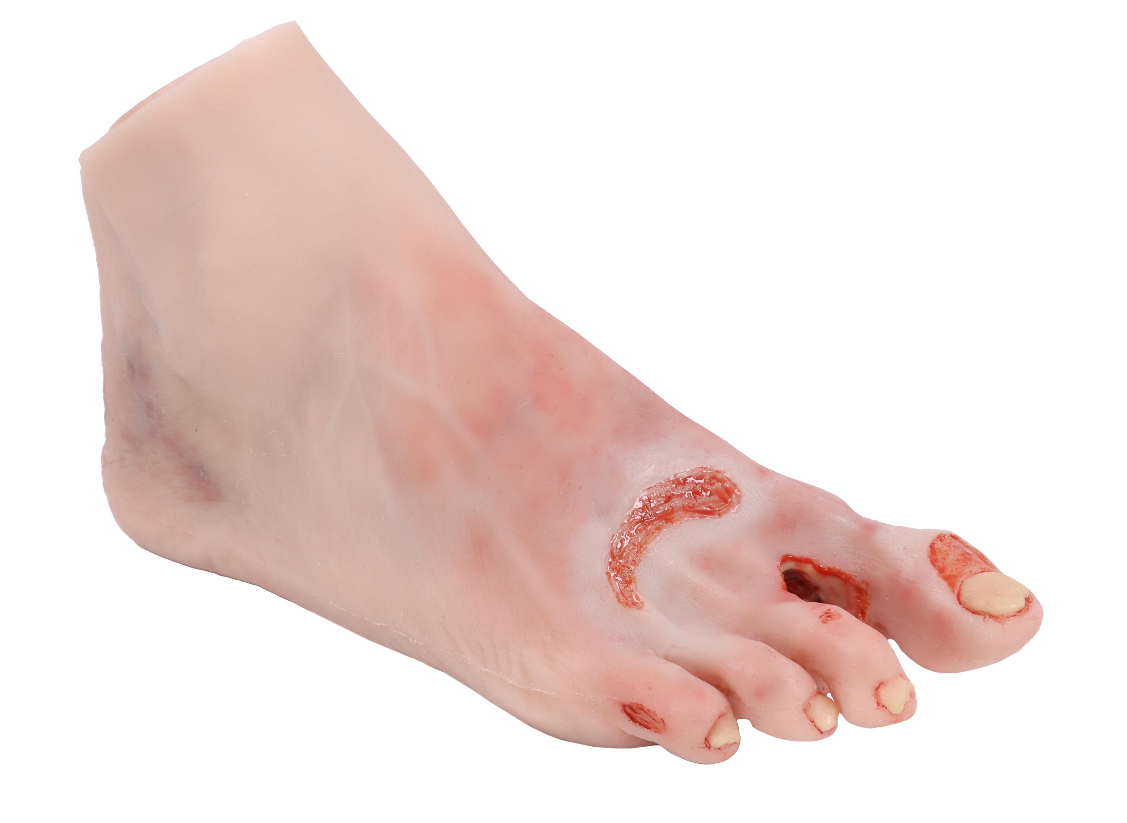 Wound-foot-with-diabetic-foot-syndrome-severe-stage